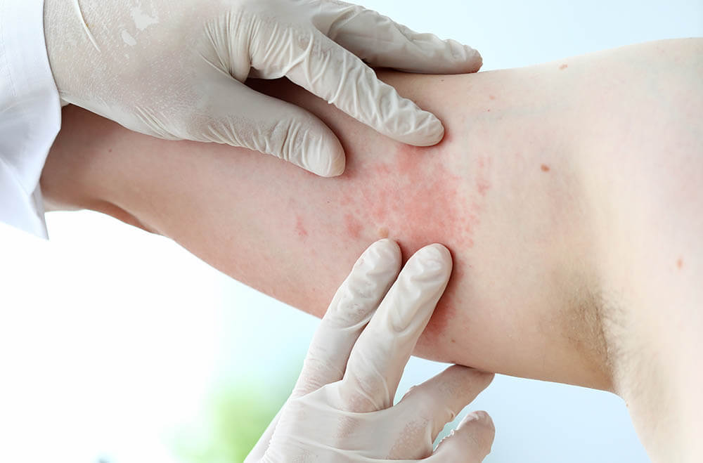 latex_allergy_rash.jpg
